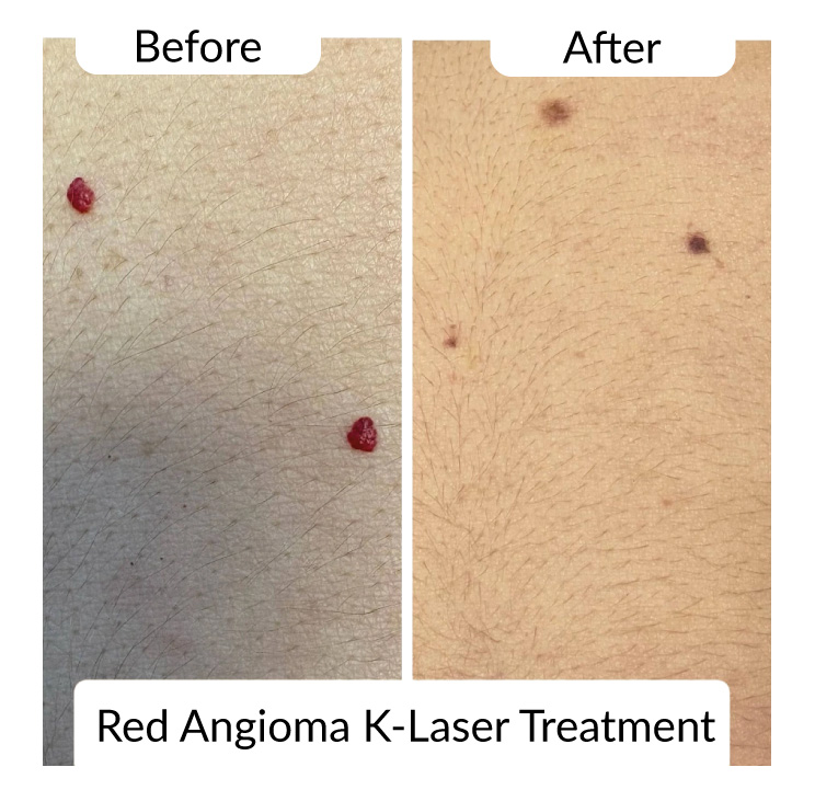red angioma klaser before after