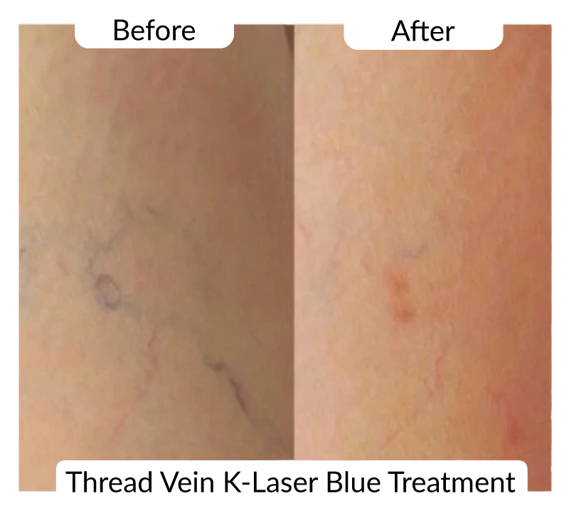 ead vein klaser before after